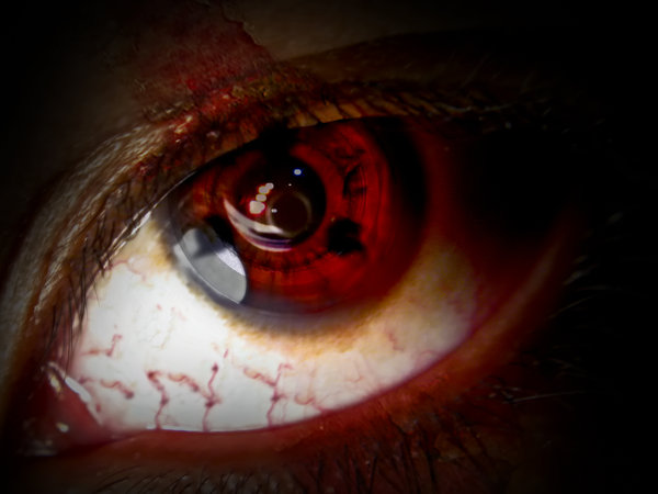OJOS ROJOS, UN SIGNO DE CORONAVIRUS?